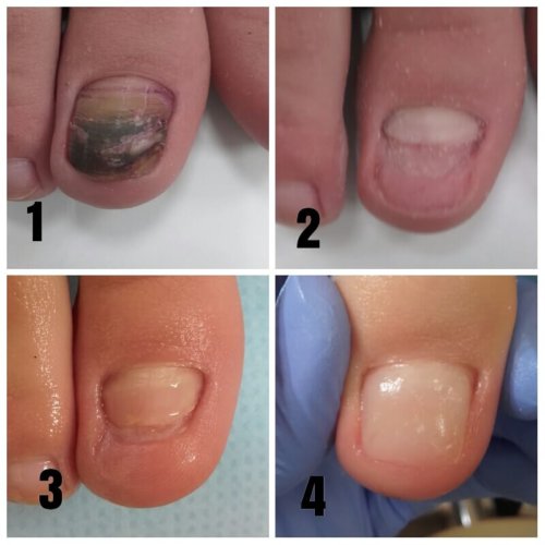Etapy przeprowadzania rekonstrukcji paznokcia